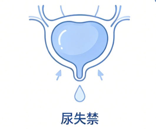 尿失禁