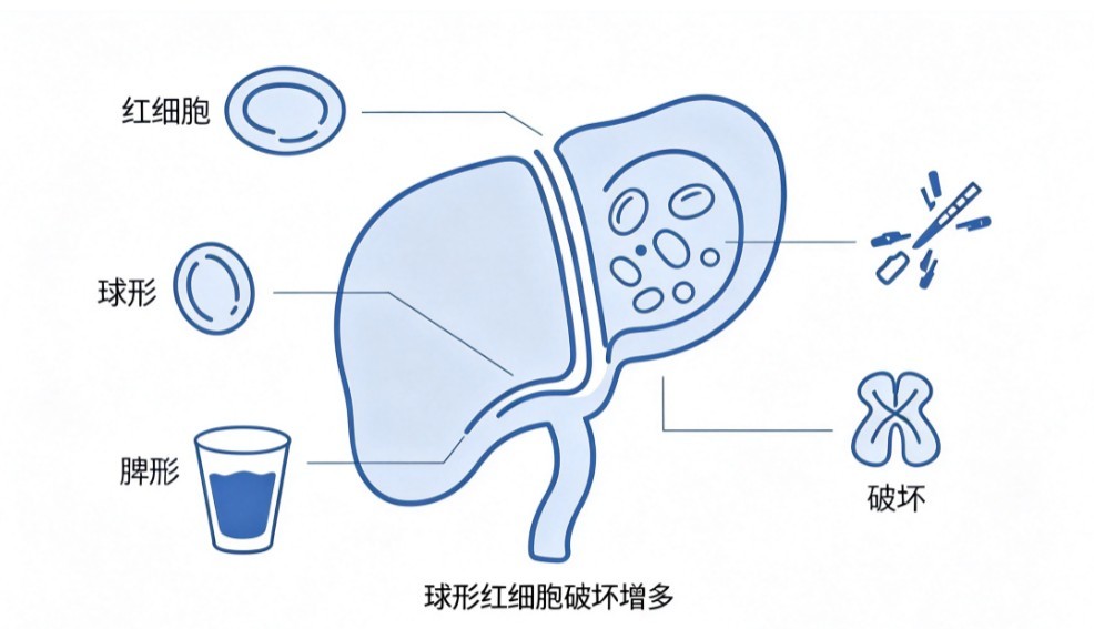 遗传性球形红细胞增多症