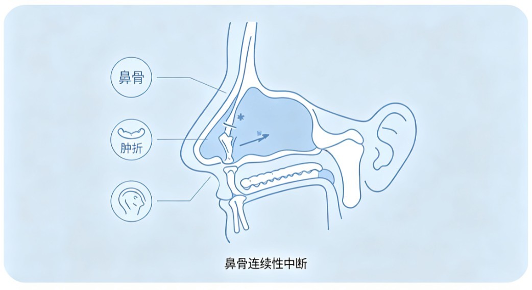 鼻骨骨折
