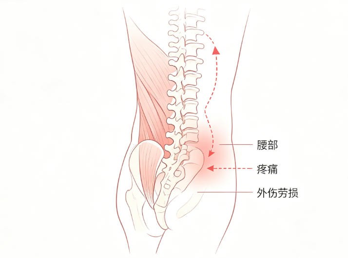 慢性单纯性外伤性腰腿痛