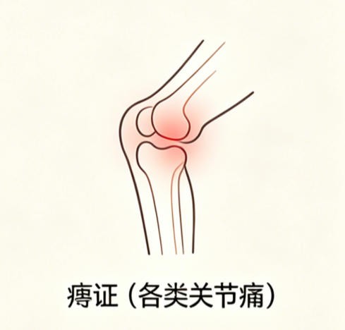 痹证