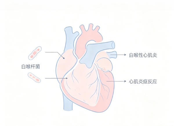 白喉性心肌炎