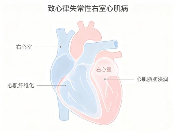 致心律失常性右室心肌病