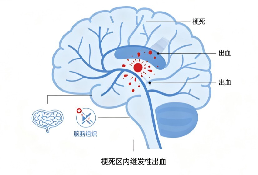 出血性脑梗死