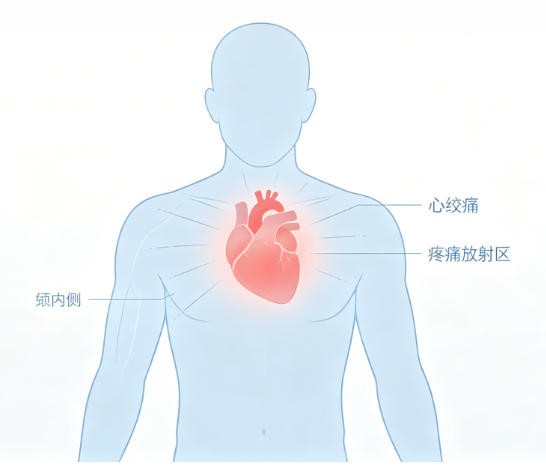 心绞痛