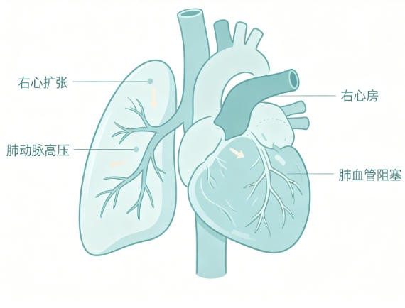 急性肺源性心脏病