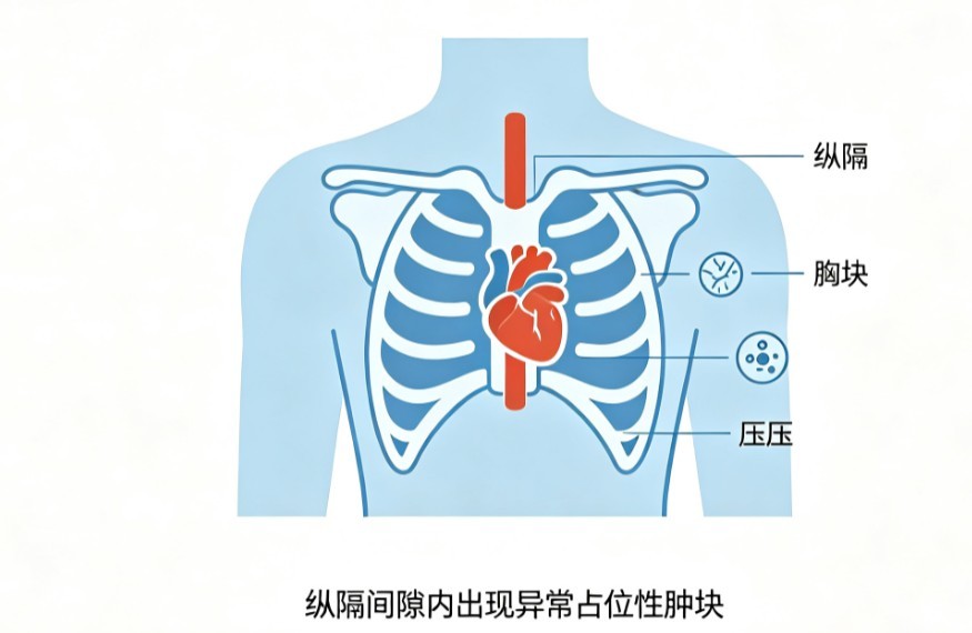 纵隔肿瘤