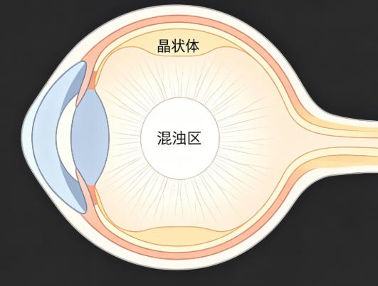 外伤性白内障