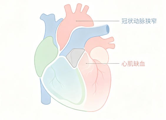 缺血性心肌病