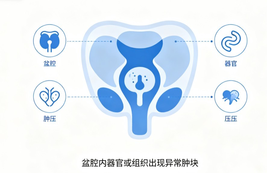 盆腔肿瘤