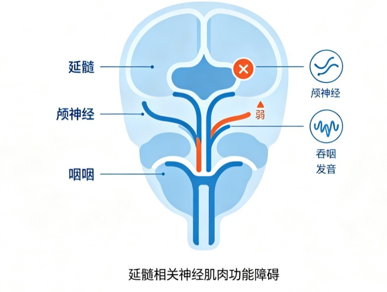 球麻痹