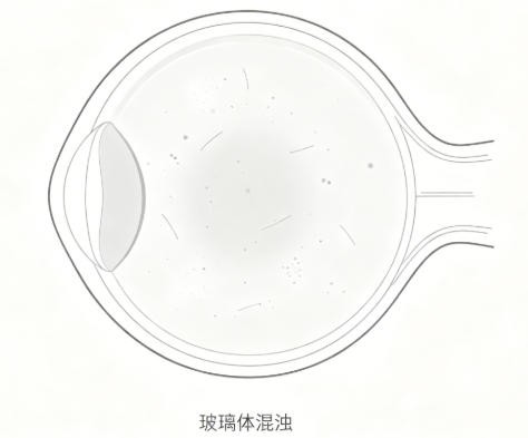 玻璃体混浊