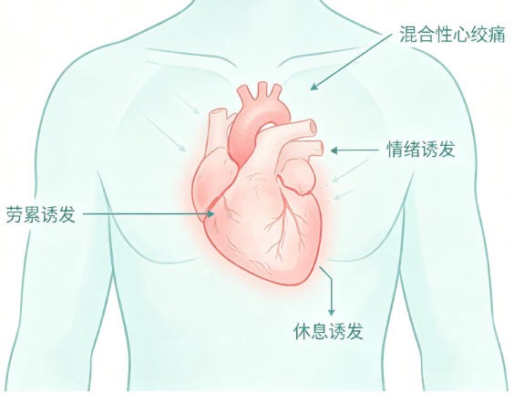 混合性心绞痛