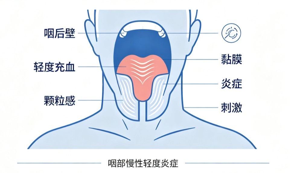 慢性单纯性咽炎