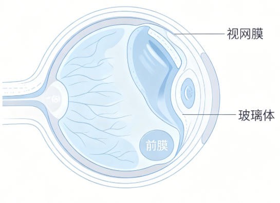 视网膜前膜