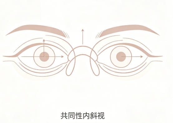 共同性内斜视