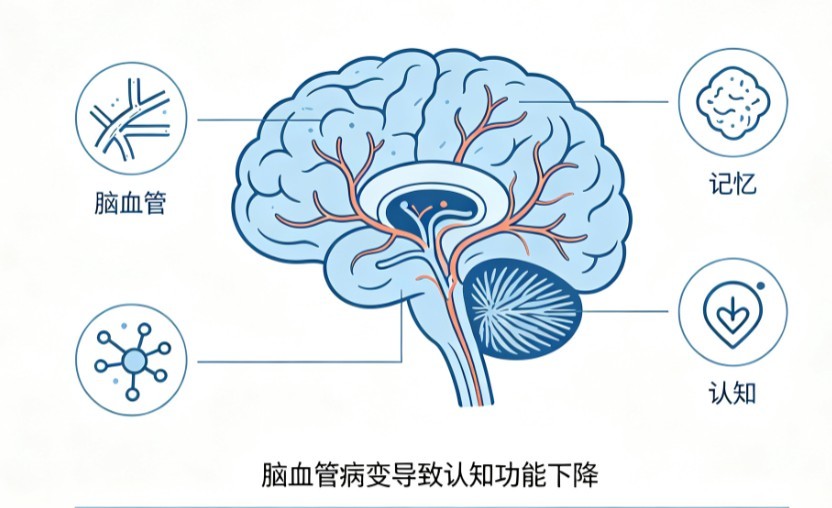 老年血管性痴呆