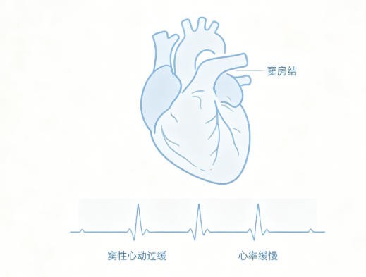 窦性心动过缓