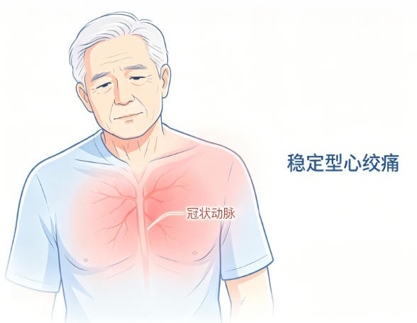 老年稳定型心绞痛