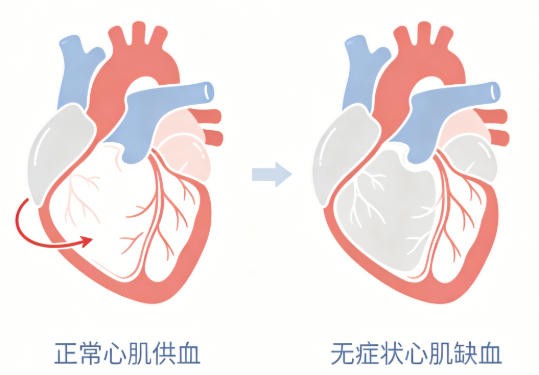 无症状型心肌缺血