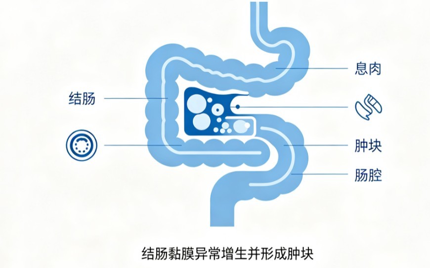 结肠癌
