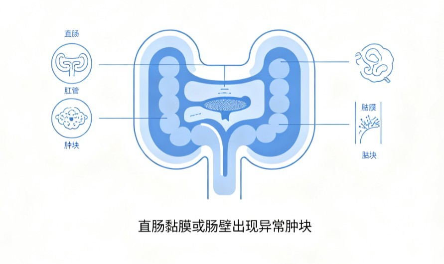直肠癌