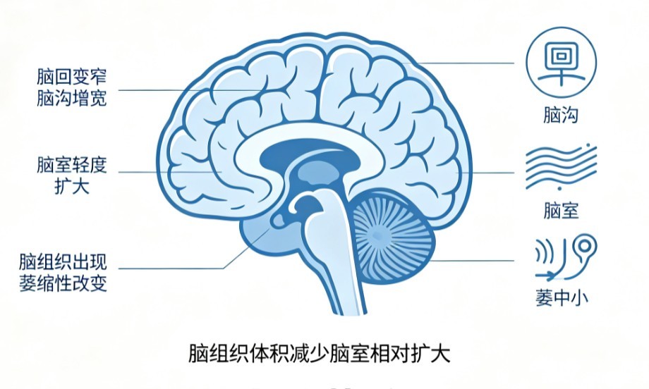 大脑萎缩