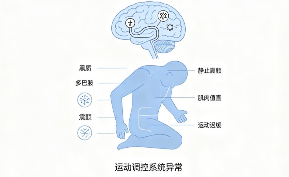 帕金森综合征