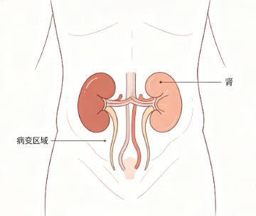 肾疳