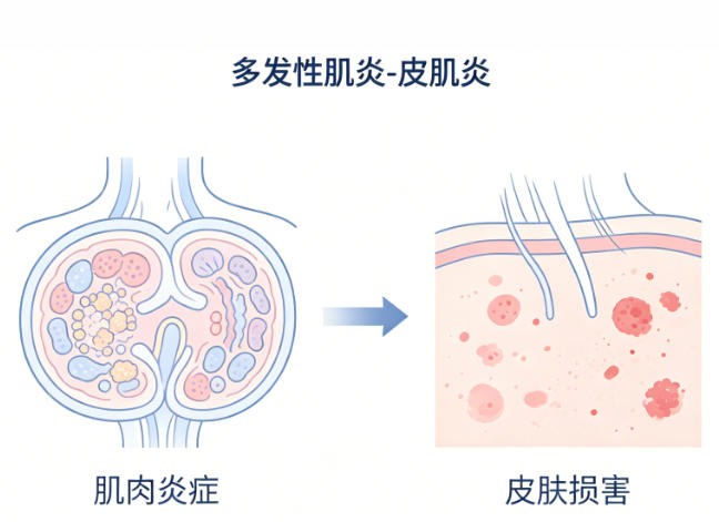 多发性肌炎 - 皮肌炎
