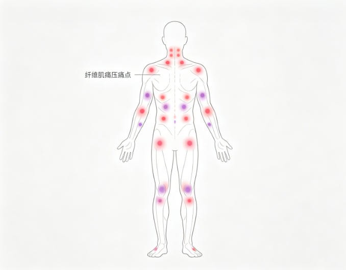 纤维肌痛综合征