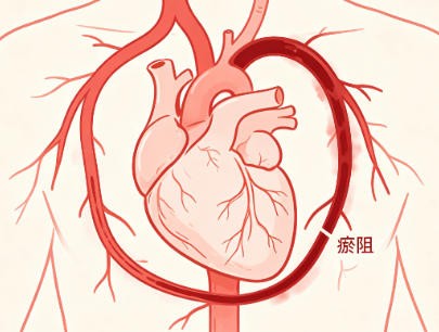 心血瘀阻