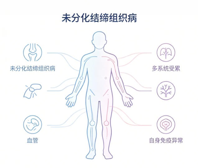 未分化结缔组织病