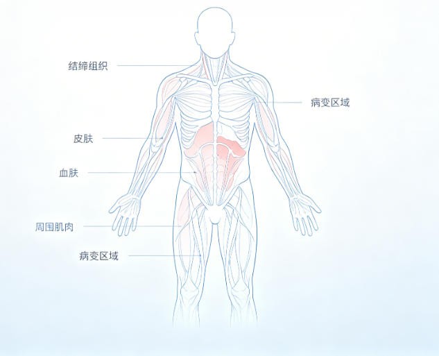 结缔组织病