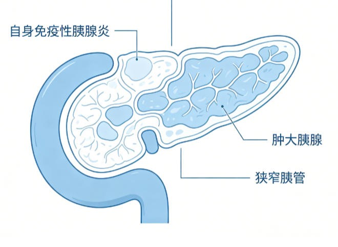 自身免疫性胰腺炎