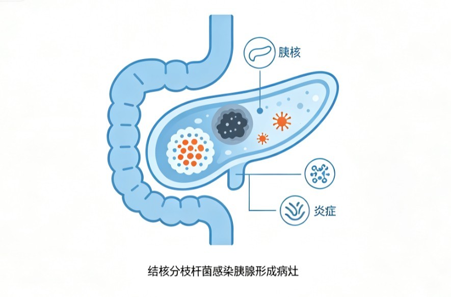 胰腺结核