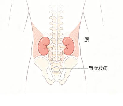 肾虚腰痛