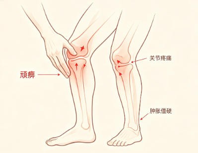 顽痹