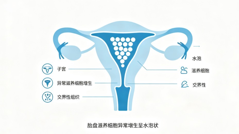 葡萄胎