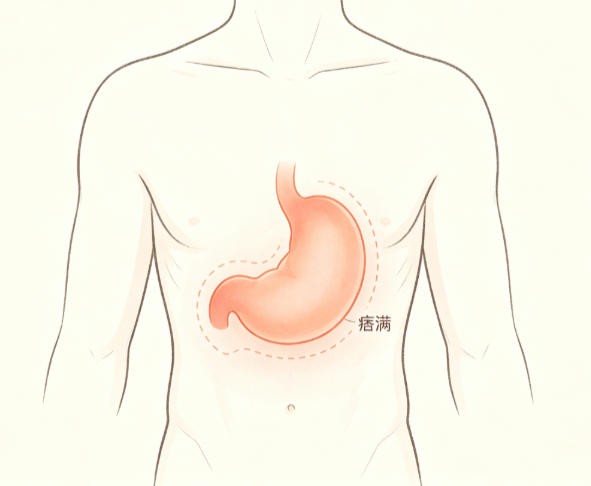 痞满