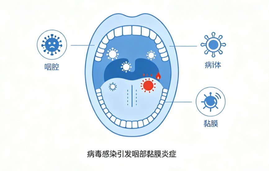 病毒性咽炎