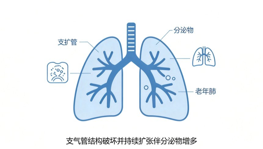 老年支气管扩张