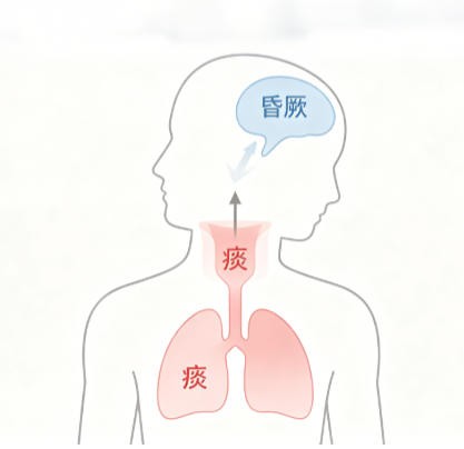 痰厥