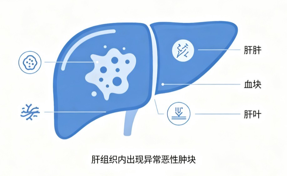 肝癌