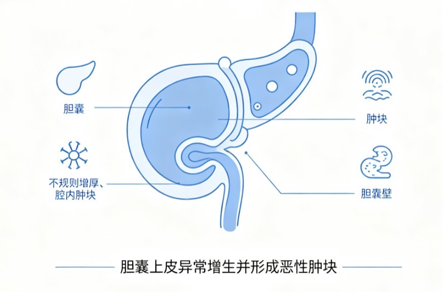 胆囊癌