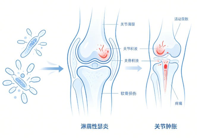 淋病性关节炎