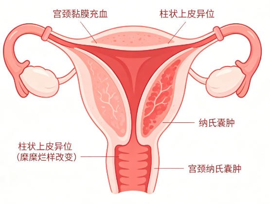 慢性宫颈炎