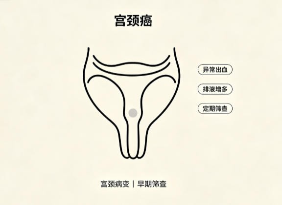 宫颈癌