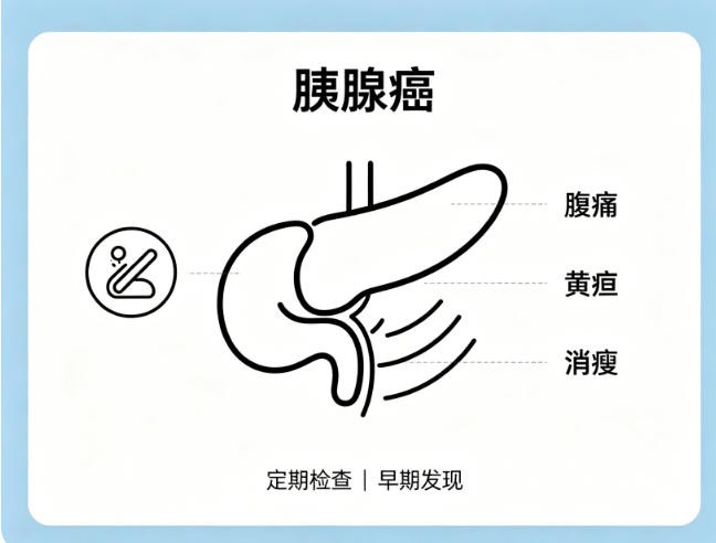 胰腺癌