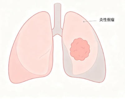 肺炎性假瘤